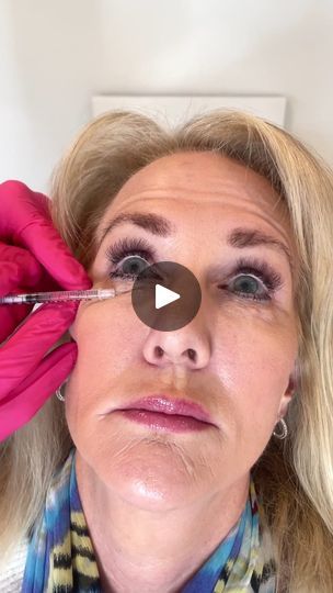 Under Eye Botox Before And After, Botox For Lower Face, Baby Botox Before And After, Botox Under Eyes, Botox Eyes, Botox Locations On Face, Botox Forehead Injection Sites, Natural Botox For Wrinkles Dr. Oz, Botox Before And After