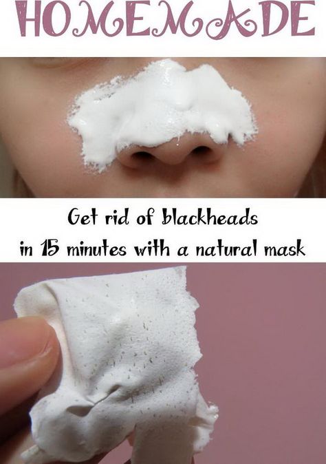 Obličejové Masky, Make Up Diy, Rid Of Blackheads, Natural Mask, Face Mask Recipe, Get Rid Of Blackheads, Beauty Remedies, Homemade Face, Homemade Face Masks