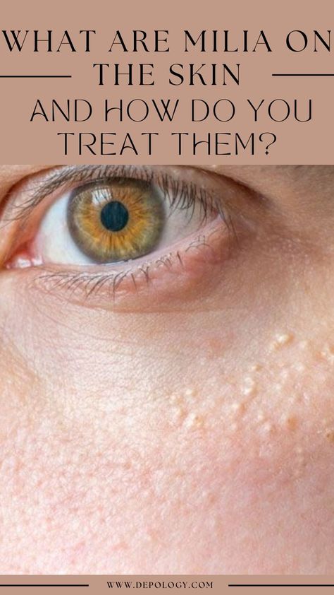 If you've ever seen small, white bumps on your skin, you may be dealing with milia. Milia are different than whiteheads and acne. They are very common, typically not harmful, and can happen to anyone at any age. But what exactly are they? We'll cover common causes of milia and ways to prevent and treat them. White Pimples On Face, Skin Bumps On Face, White Bumps On Skin, White Bumps On Face, Small Bumps On Face, Bumps Under Eyes, Head Pimples, Forehead Bumps, Head Acne