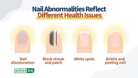 Nail Health Signs, White Spots On Nails, Nail Discoloration, Peeling Nails, Nail Conditions, Health Signs, Hard Nails, Damaged Nails, Lines On Nails