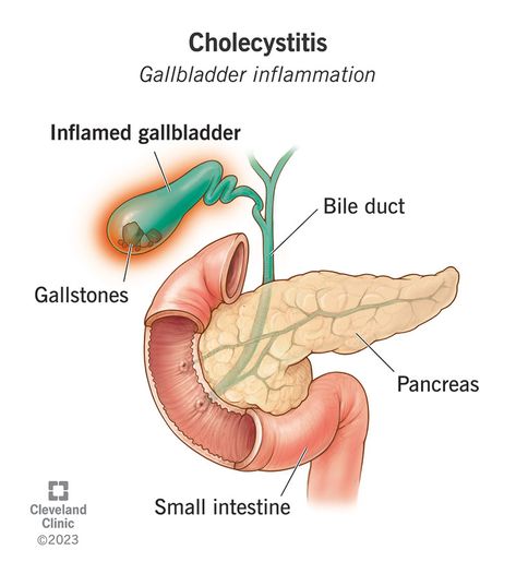 Gallbladder Attack, Gallbladder Stones, Gallbladder Surgery, Signs Of Inflammation, Bile Duct, Laparoscopic Surgery, Black Quotes, Cleveland Clinic, White Blood Cells