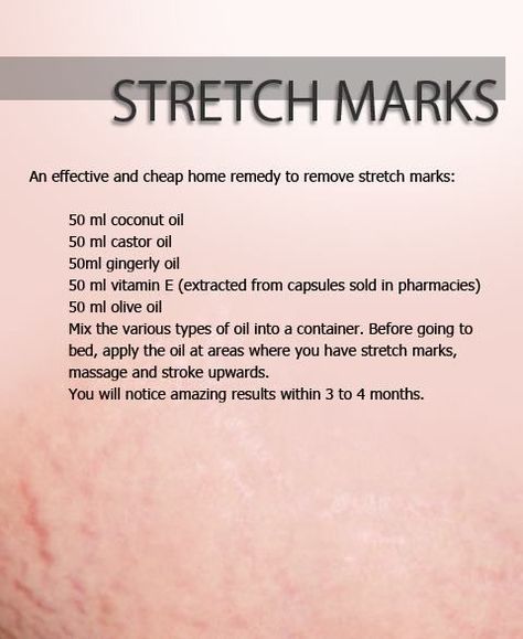 Stretch Mark Remedies, Stretch Mark Removal, Stretch Mark, Beauty Remedies, Skin Remedies, Homemade Beauty Products, Health And Beauty Tips, Beauty Treatments, Hair Skin