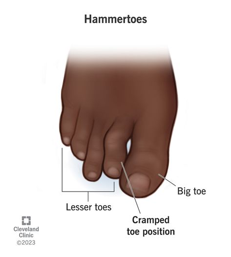 A podiatrist will suggest treatments like orthotics, wearing different shoes or surgery. Here’s everything you need to know about hammertoes. Different Shoes, Developmental Stages, Cleveland Clinic, Foot Care, Health Articles, Medical Conditions, Blood Flow, Surgery, Disease