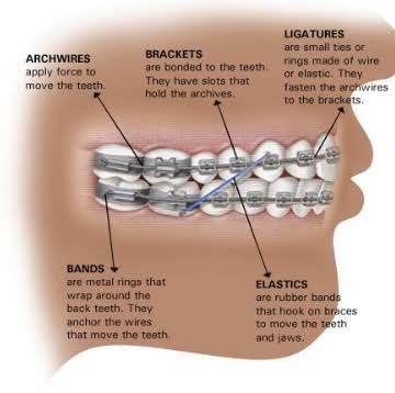 Parts of orthodontic braces. Orthodontist Assistant, Dental Assistant Study Guide, Dental Charting, Dental Assistant School, Dental Hygienist School, Dental Assistant Study, Dentist Assistant, Orthodontic Appliances, Dental Videos