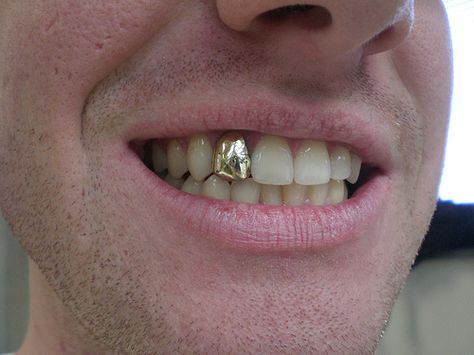 Gold Teeth Men, Permanent Gold Teeth, Gold Tooth Cap, Tooth Cap, Teeth Covers, Gold Tooth, Grillz Teeth, Teeth Caps, Gold Grill