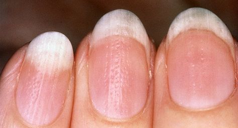 Subtle changes in the color or texture of your nails may be a sign of disease elsewhere in the body. WebMD shows you what secrets might be hiding at your fingertips. Bluish Nails, Nail Health Signs, White Spots On Nails, Pale Nails, Jumper Nails, Split Nails, Skin Center, Opal Nails, Spine Pain