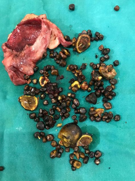 DONT TAKE GALL BLADDER STONES LIGHTLY Bladder Stones, Gall Bladder, Small Pet, Travel Bags, Surgery, Pet, Stone, Travel, Quick Saves