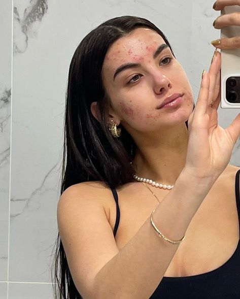 Girl With Acne, Daisy Acrylic Nails, Celebrity Acne, Acne Prone Skin Care, Chic Nail Art, Acne Studio, Healthy Skin Tips, Face Acne, Facial Skin Care Routine