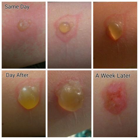 2nd Degree Burn I got a couple of years back. How To Heal Burned Skin, 2nd Degree Burns, Degree Burns, Medical Student Study, Student Studying, Reference Photos, Skin Conditions, A Couple, Medical