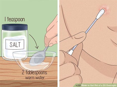 How to Get Rid of a Zit Overnight (with Pictures) - wikiHow Skin