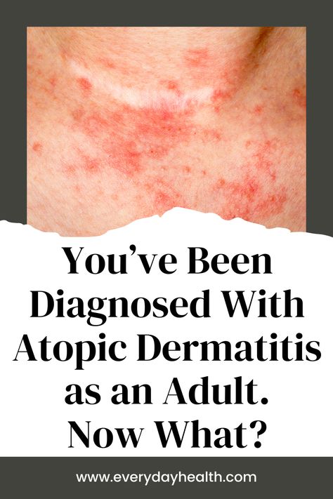 An atopic dermatitis diagnosis in adulthood can feel overwhelming, but these next steps can bring relief and a clear path forward. Atopic Dermatitis May Look Different in Adults Than in Children How an Adult Atopic Dermatitis Diagnosis Might Change Your Life 5 Important Next Steps After an Adult Atopic Dermatitis Diagnosis Although atopic dermatitis — the most common type of eczema — is most often diagnosed among young children, the condition can develop at any age, including during adulthood. Contact Dermitis Rash, Atopic Dermitis Remedy, Best Oil For Skin, Home Remedies For Pimples, Pimples Remedies, Face Care Routine, Forehead Wrinkles, How To Move Forward, Health Tools