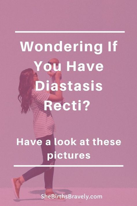 It is possible to heal your Diastasis Recti and lose your Mommy tummy? Need some inspiration? Then have a look at these before and after pictures of women who restored their core by following an exercise program and consistently working out. Click for a visual guide to diastasis recti.  #shebirthsbravely #doula #postpartum #diastasisrecti #mommytummy #fourthtrimester How To Check For Diastasis Recti, Correcting Diastasis Recti, Best Exercise For Diastasis Recti, Mommy Pooch Workout Diastasis Recti, Core Exercises For Diastasis Recti, Mommy Tummy Before And After, Diastasis Recti Symptoms, Healing Diastasis Recti Years Later, Heal Diastasis Recti Fast