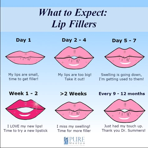 Lip Filler, Radiate Confidence, Lip Fillers, Price Comparison, Pros And Cons, Different Types, Budgeting, Every Day