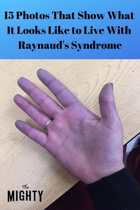 Raynauds Disease Remedies, Reynauds Syndrome Symptoms, Raynauds Disease Symptoms, Reynauds Syndrome, Raynauds Syndrome, Reynauds Disease, Raynauds Phenomenon, Pure Autonomic Failure, Lymes Disease