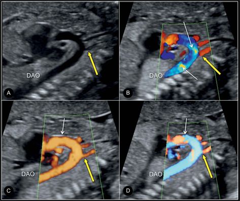 Pediatric Ultrasound, Fetal Echocardiography, Cardiac Assessment, Diagnostic Medical Sonography Student, Obstetric Ultrasound, Fetal Doppler, Flow Map, Sonography Student, Diagnostic Medical Sonography