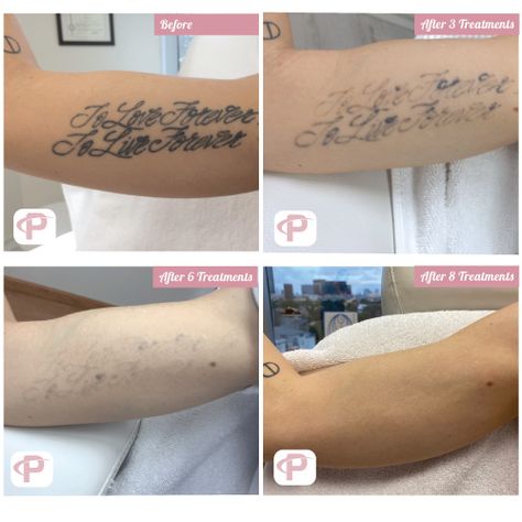 Laser tattoo removal before and after picture. Lazer Removed Tattoo Before And After, Tattoo Before And After, Laser Tattoo Removal Before And After, Tattoo Removal Before And After, Experience Tattoo, Tattoo Regret, No Regrets Tattoo, Laser Removal, Abstract Art Images