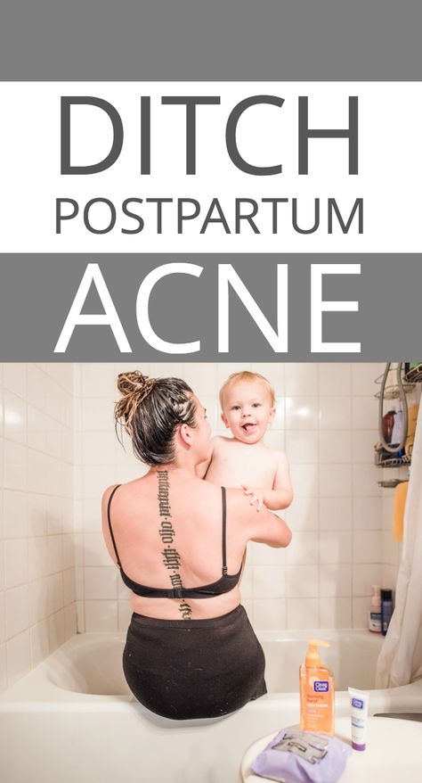 Learn How to ditch postpartum acne (without seeing a dermatologist) – for good! #somedayilllearn #diy #healthylivingtips #acnefree #clearskin #beautytips Postpartum Acne, Acne Hacks, Postpartum Care Kit, Hacks Every Girl Should Know, Acne Skincare Routine, Creative Circle, Beauty Routine Tips, Postpartum Care, Acne Free