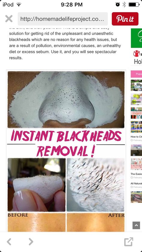 Black Heads Obličejové Masky, Aesthetic Health, Hacks Every Girl Should Know, Blackhead Removal, Remove Blackheads, Get Rid Of Blackheads, Beauty Remedies, Homemade Beauty Products, Blackhead Remover