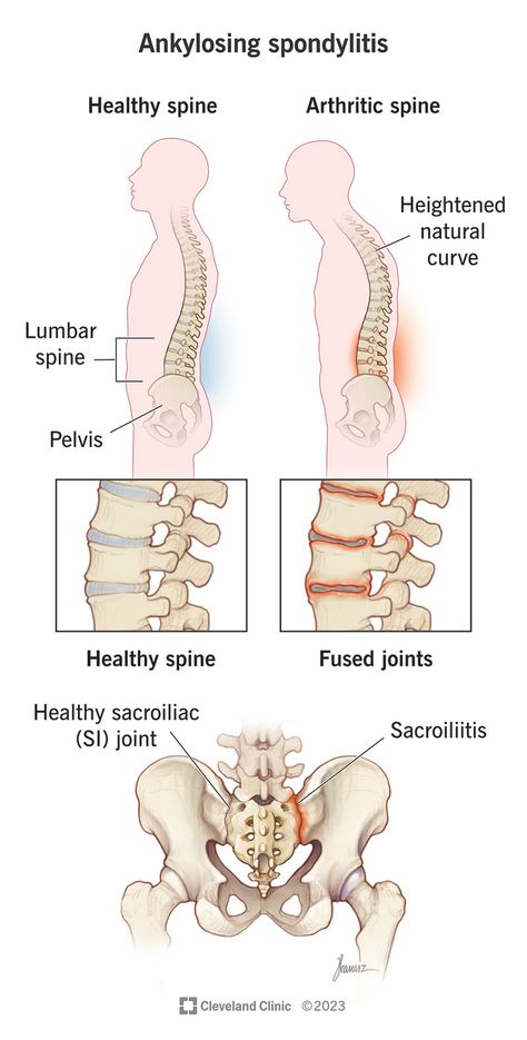 What Is Ankylosing Spondylitis? Stenosis Of The Spine, Higher Art, Rheumatic Diseases, Healing Thoughts, Skeletal System, Medical Knowledge, Medical Information, Low Back Pain, Autoimmune Disease