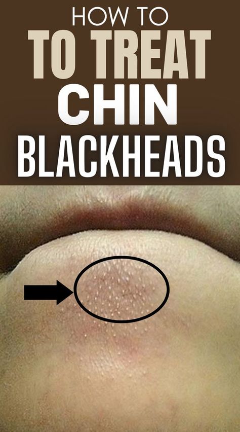 How to Quickly and Easily Remove Blackheads from Your Chin at Home #Remedies #HomeRemedies #NaturalRemedies #Blackheads #Skincare #SkincareTips #blackheadproblems #skinhealth. Find out more here 👉 https://whispers-in-the-wind.com/effective-ways-to-get-rid-of-blackheads-expert-tips/?blackheads Blackheads On Face, Blind Pimple, Blackheads On Nose, Face Pores, How To Get Rid Of Pimples, Remove Blackheads, Get Rid Of Blackheads, Unwanted Hair Removal, Homemade Face