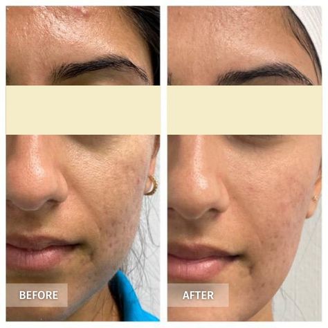 Morpheus8 Before And After, In The Arms Of Morpheus, Morpheus 8 Before And After Face, Morpheus Offerings, Morpheus Splintered, Morpheus 8, Health Skin Care, Beauty Goals, Beauty Treatments