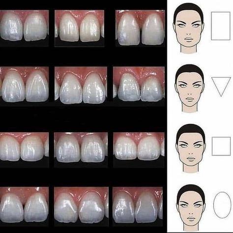 Prosthodontics Dentistry, Dental Lab Technician, Dental Ceramics, Teeth Anatomy, Esthetic Dentistry, Dental Photos, Dental Aesthetics, Dental Videos, Dental Photography