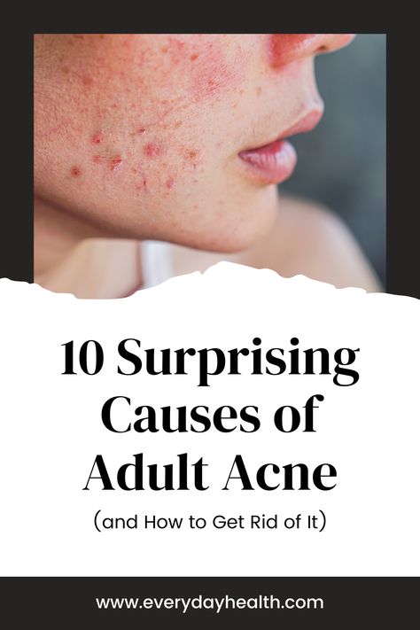 How to Get Rid of Adult Acne
Why Am I Breaking Out
Still battling annoying acne as an adult? Here are some causes you may not have expected — and the solutions dermatologists recommend for making acne go away. As you age, you might think you're past the age of getting teenage acne. Although hormonal changes during puberty is a common cause of acne — about 80 percent of preteens and teens experience it — that isn't the only thing that can cause pimples. Cause Of Acne, Fragrance Free Skin Care, Teenage Acne, Skincare For Oily Skin, Anti Redness, Acne Causes, 80 Percent, Clean Beauty Products, Glycemic Index