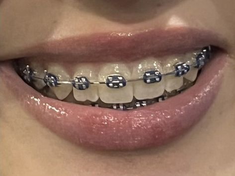 Brackets Aesthetic, Perfect Teeth Braces, Teeth With Braces, Silver Braces, Black Braces, Cute Braces Colors, Braces Tips, Getting Braces, جوني ديب