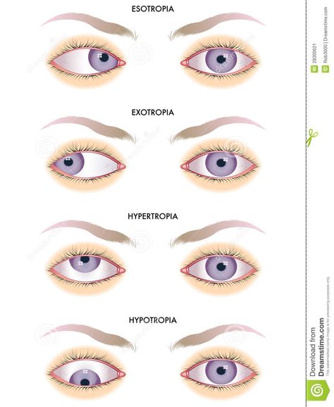 Strabismus - Download From Over 45 Million High Quality Stock Photos, Images, Vectors. Sign up for FREE today. Image: 28300621 Eye Anatomy Notes, Optometry Education, Optometry School, Anatomy Notes, Eye Facts, Eye Anatomy, Vision Therapy, Medical Student Study, Medicine Student