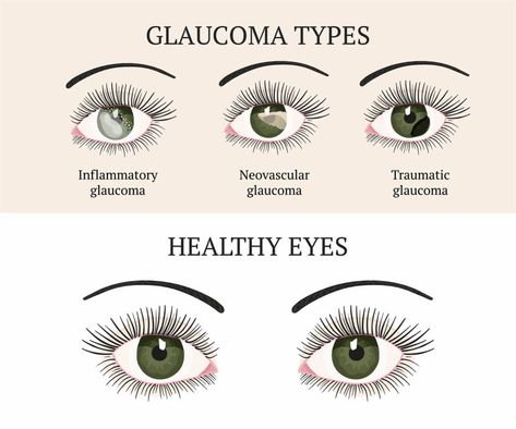 All About Copper Gluconate Opthalmic Technician, Eye Facts, Eye Anatomy, Blurry Vision, Eye Exercises, Vision Loss, Vision Problems, Healthy Eyes, Eyes Problems