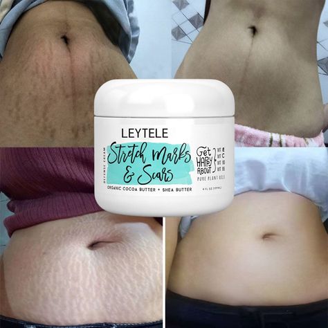 Stretch Mark Cream Pregnancy, Stretch Mark Removal Cream, Skin Repair Cream, Marks Cream, Scar Cream, Stretch Mark Cream, Stretch Mark Removal, Cream Body, Stretch Mark