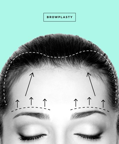 Brow Lift Surgery, Rhinoplasty Recovery, Bad Plastic Surgeries, Forehead Lift, Eyebrow Lift, Plastic Surgery Procedures, Under The Knife, Brow Lift, Nose Job