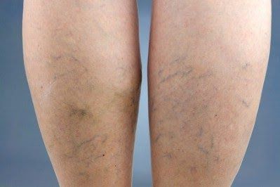 Shrink varicose veins. Witch Hazel Uses, Teeth Remedies, Varicose Vein Remedy, Vein Removal, Skin Care Remedies, Health Remedies, Natural Health, Home Remedies, Natural Remedies