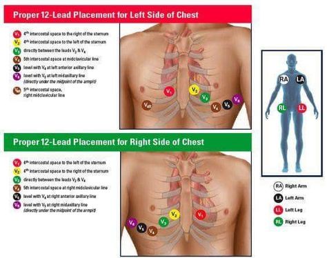 12 lead placement 12 Lead Ekg Placement, Ecg Placement, Ekg Placement, Lead Placement, Medical Assistant School, Emt Study, Nursing Labs, Nurse Skills, Cardiology Nursing