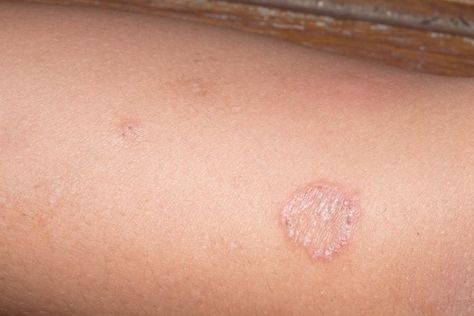 Skin Rashes and causes Ringworm Types Of Skin Rashes, Common Skin Rashes, Body Rash, Aloe Vera For Sunburn, Rash On Neck, Types Of Rashes, Rash Causes, Dry Skin Remedies, Home Remedies For Hair