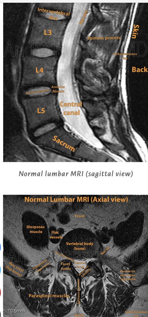 Mri Spine, Medical Radiography, Scrub Collection, Radiology Student, Radiology Imaging, Intervertebral Disc, Anatomy Bones, Spina Bifida, Ct Scan