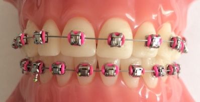 Pink themed elastics for; Barbie, Hello Kitty, Valentines or just because you love PINK! Light Pink Braces, Pink Braces, After Braces, Braces Tips, Getting Braces, Jaffa Cake, Girl Film, Braces Colors, Dental Braces