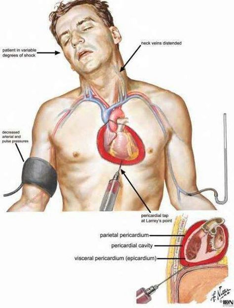 Cardiac Tamponade Cardiac Tamponade, Anatomy Of The Heart, Emt Basic, Internal Anatomy, Medical Terminology Study, Cardiac Nursing, Critical Care Nursing, Nursing School Tips, Medical Terminology