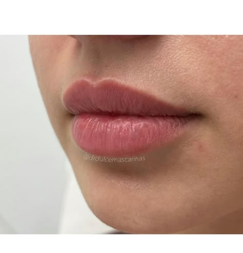 Pouty Upper Lip, Natural Lip Injections Before And After, Julie Horne Lip Filler, 2 Ml Lip Filler, Healed Lip Filler, Small Mouth Lip Fillers, Lip Filler Inspiration 0.5ml, Lip Shapes Filler, Lip Filler Natural Look