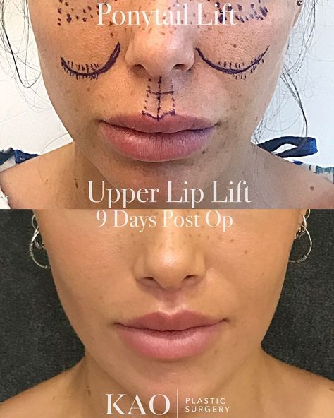 Ponytail Lift, Upper Lip Lift, Lip Surgery, Lip Lift, Facial Procedure, Rhinoplasty Nose Jobs, Nose Reshaping, Face Fillers, Upper Lip Hair