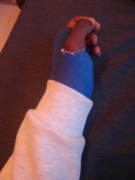 Broken Hands Fake Story, Arm Cast Aesthetic, Broken Arm Cast, Fractured Arm, Fake Injury, Broken Finger, Arm Cast, Gangsta Quotes, Broken Arm