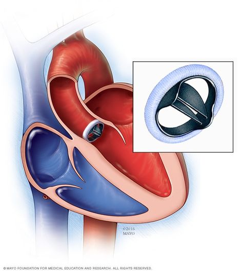 Mechanical valve replacement Heart Valves Anatomy, Valves Of The Heart, Artificial Heart, Heart Valves Disease, Heart Valve, Aortic Valve Replacement Surgery, Heart Valves, Bicuspid Aortic Valve, Congenital Heart