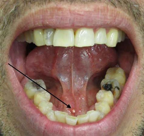 What to know about salivary stones Salivary Gland Infection, Salivary Gland Stone, Salivary Glands, Parotid Gland, Throat Infection, Not Drinking Enough Water, Sjogrens Syndrome, Salivary Gland, Strep Throat