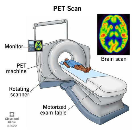 PET Scan: What It Is, Types, Purpose, Procedure & Results Pet Scan Image, Ct Scan Aesthetic, Brain Issues, Psychology A Level, Brain Disorders, Pet Ct, Pet Scan, High Contrast Images, Medical Wallpaper