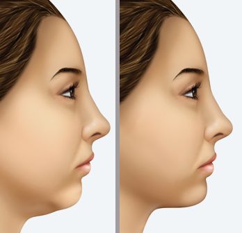 Learn Acupressure Strategies To Reduce And Tighten A Second Chin Without Surgery Double Chin Removal, Facelift Without Surgery, Sagging Face, Chin Augmentation, Chin Implant, Face Lift Exercises, Double Chin Exercises, Face Firming, Chin Exercises