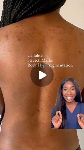 Dr Kemi Fabusiwa on Instagram: "Cellulite, stretch marks, and body hyperpigmentation? 😠 Don’t stress! As your friendly neighborhood doctor, here’s the tea 🍵 on how to tackle these common concerns:  💦 Body Hyaluronic Acid: It’s like a tall glass of water for your skin, plumping it up & smoothing out cellulite and. Hydrated skin = happy skin! 💧  ✨ Body Retinoid: This magic potion boosts collagen, fading stretch marks & giving your skin that “I woke up like this” glow.   🌞 Body SPF 30+: Your ride-or-die against the sun’s rays. Protects your progress. Don’t skip this step! 🧴  🏋️‍♀️ PSA: Hitting the gym can help tighten things up, too. Let’s get snatched! 💪 #skincarehacks #bodygoals #glowup  🔑 Consistency is key: Don’t expect overnight miracles. Give these products time to work their m Body Hyperpigmentation, Abdominal Stretches, Best Body Oil, Strech Marks, Body Skin Tightening, Stretch Mark Remedies, Pregnancy Skincare, Face Care Routine, Magic Potion