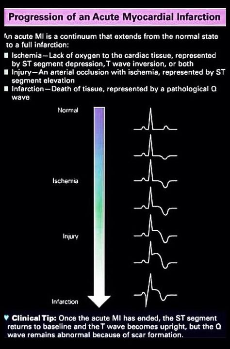 Ekg Lead Placement, Lead Placement, Healthcare Assistant, Er Nursing, Adulting 101, Medicine Notes, Pa School, Cardiac Nursing, Er Nurse