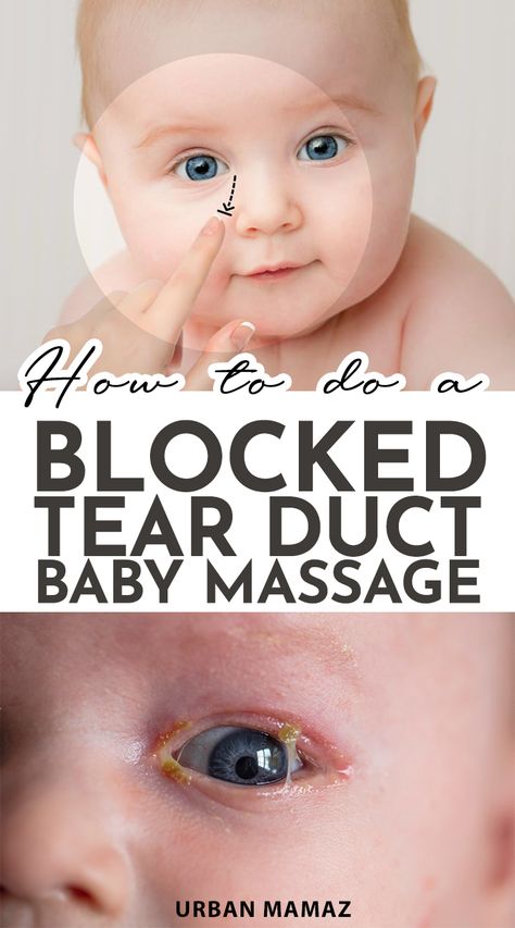 Sticky Eyes In Babies - Blocked Tear Duct Baby Massage Blocked Tear Duct Baby, Clogged Tear Duct Baby, Newborn Baby Eyes, Cough And Cold Remedies, Goopy Eyes, Sick Baby Remedies, Blocked Tear Duct, Home Remedies For Cough, Remedies For Cough