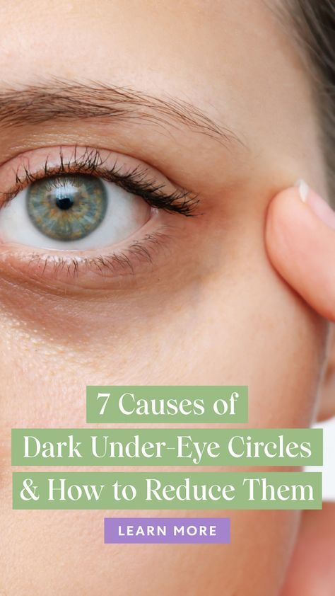 How To Get Rid Of Dark Under Eye Circles, Dark Under Eye Remedies, Dark Eye Remedies, Natural Dark Circle Remedy Under Eyes, Essential Oil For Dark Circles Under Eye, Ways To Remove Dark Circles Under Eyes, How To Get Rid Of Undereye Dark Circles, Foods For Dark Circles Under Eyes, Under Eye Circles Remedies