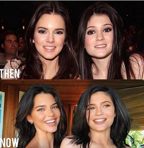 Kendall Jenner Surgery, Kendall Jenner Plastic Surgery, Kylie And Kendall, Celebrity Plastic Surgery, Celebrities Before And After, Jenner Sisters, Nose Job, Kendall And Kylie Jenner, Kardashian Jenner